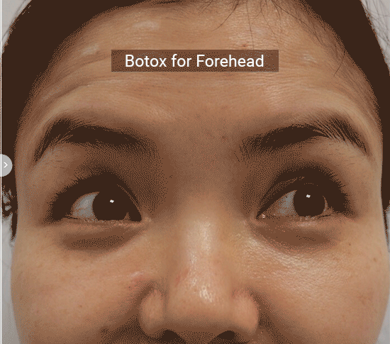 Test Page Botox (3)