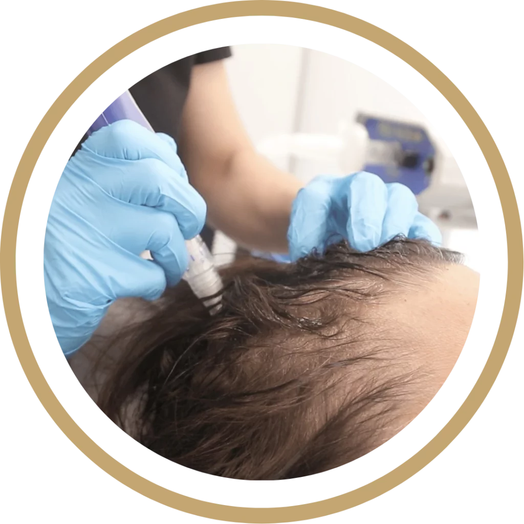 Hair Restoration | Waterloo, ON | Sunshine Cosmetic Clinic & Medi Spa