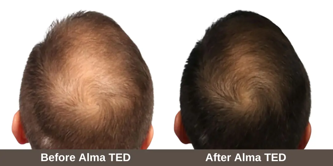 Hair Restoration | Waterloo, ON | Sunshine Cosmetic Clinic & Medi Spa
