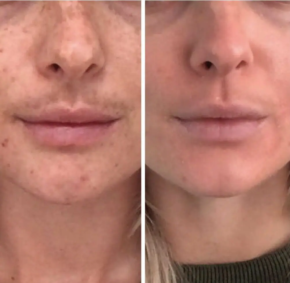 cosmelan-and-dermamelan-before-after-four