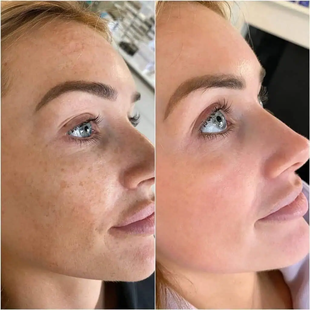 cosmelan-and-dermamelan-before-after-one