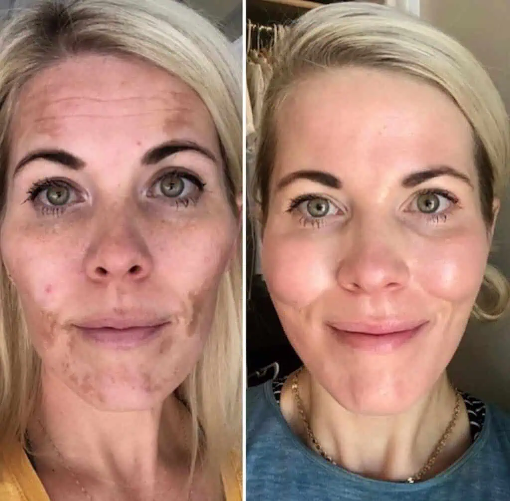 cosmelan-and-dermamelan-before-after-three
