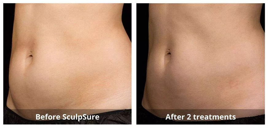 body sculpting Waterloo