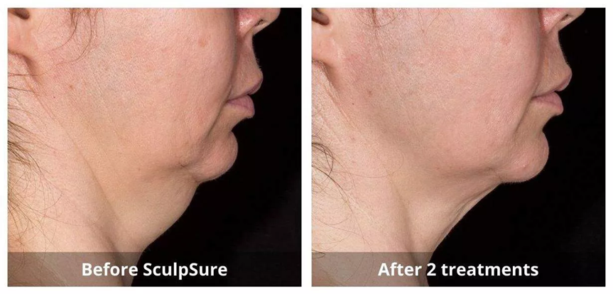 body sculpting Waterloo