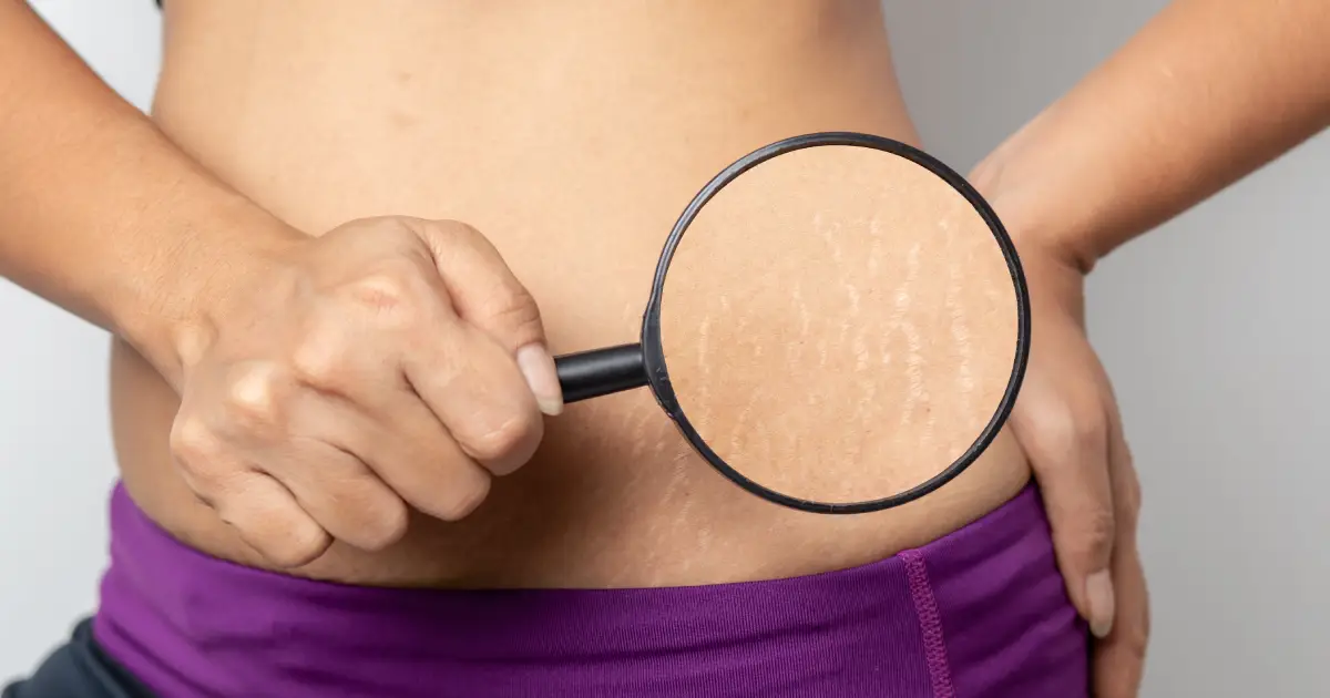 Close-up of a person examining stretch marks on their skin with a magnifying glass in Waterloo & Kitchener