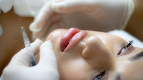 Lip Filler Kitchener – Enhance Natural Beauty with Fuller, Balanced Lips