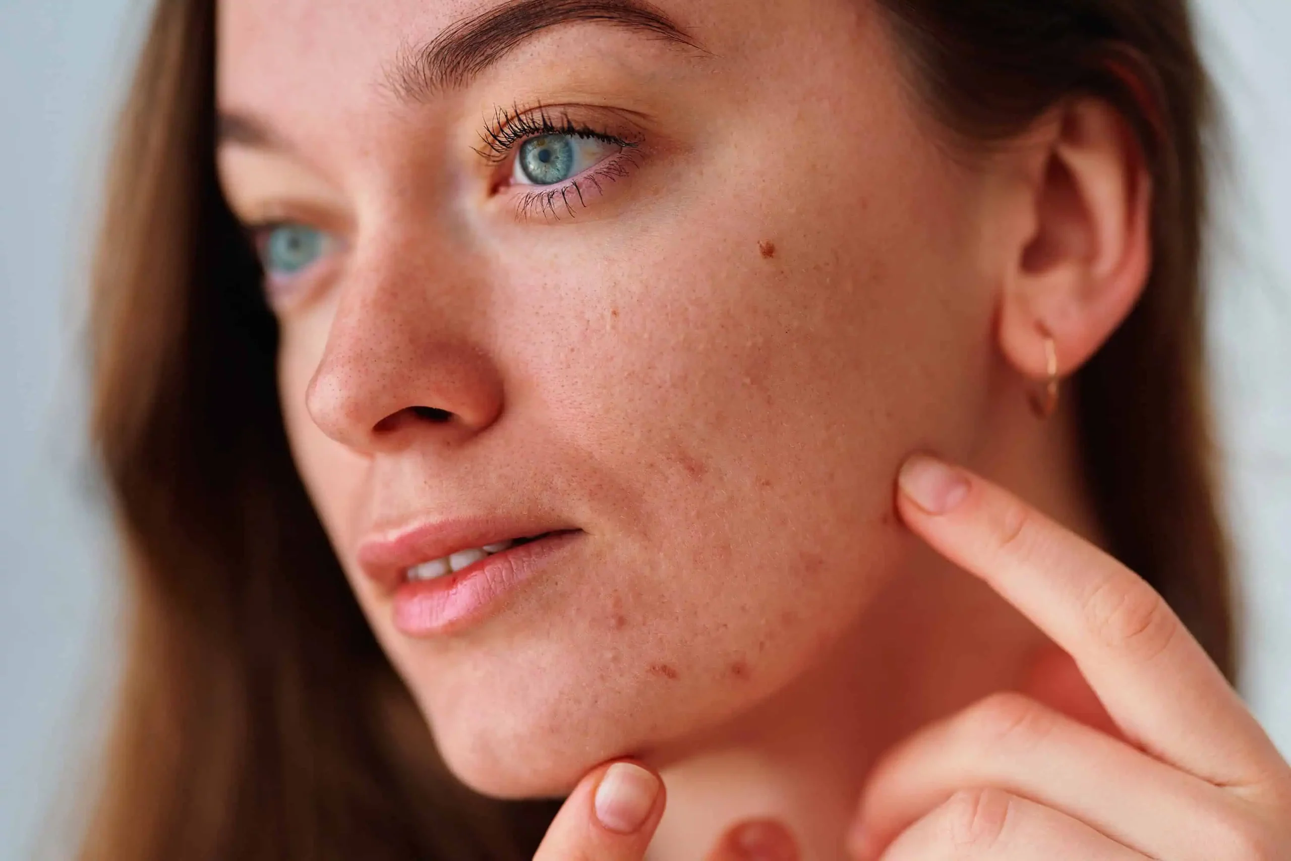 Acne Treatment Kitchener for Clearer and Healthier-Looking Skin